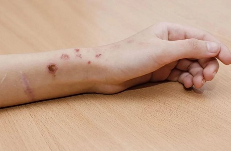 راههای تشخیص خودزنی در نوجوانان